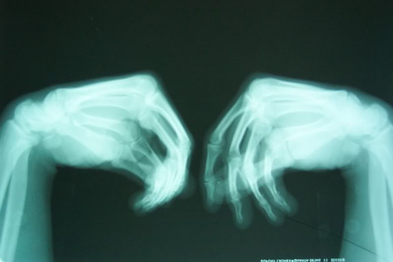 carpal-boss-photo-by-robwenzler-photobucket