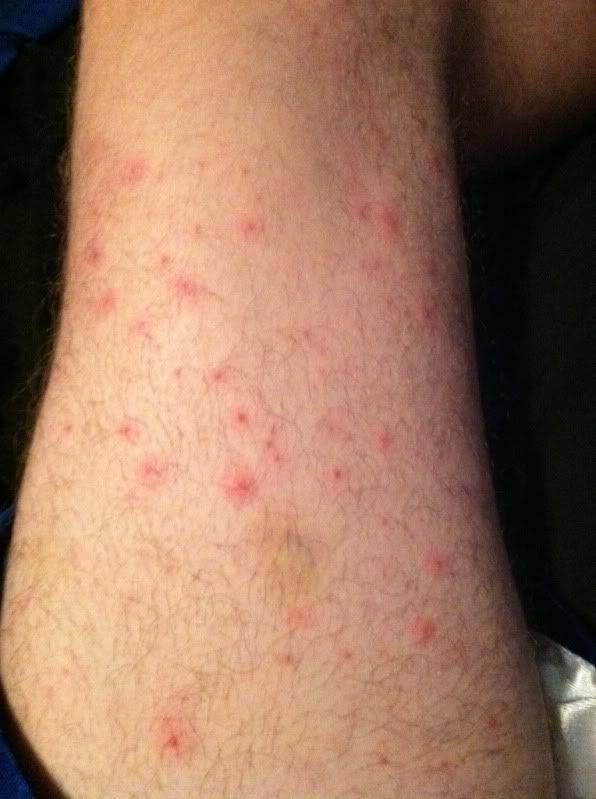 (need help) ingrown hairs on legs... - Forums at Modded ...