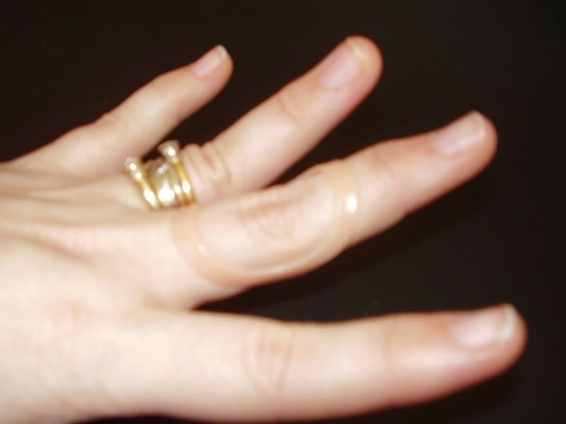 silver ring splints. was because the silver one