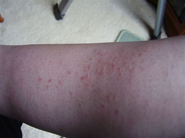 mild heat rash pictures. heat rashes on legs.