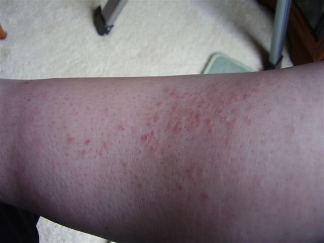 heat rash on legs. heat rash on legs.